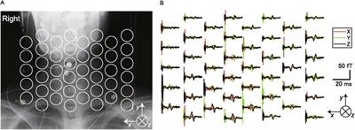 Towards non-invasive imaging through spinal-cord generated magnetic fields